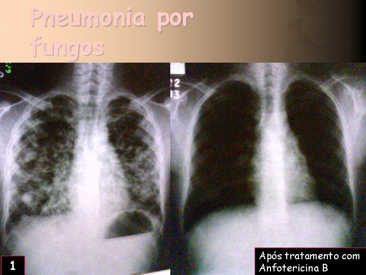 Pneumonia por fungos 1 Após tratamento com 2 Anfotericina B 