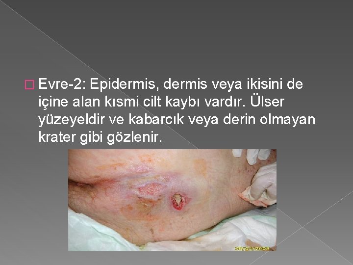 � Evre-2: Epidermis, dermis veya ikisini de içine alan kısmi cilt kaybı vardır. Ülser