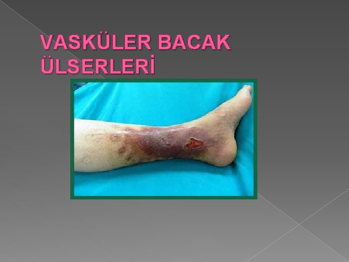 VASKÜLER BACAK ÜLSERLERİ 