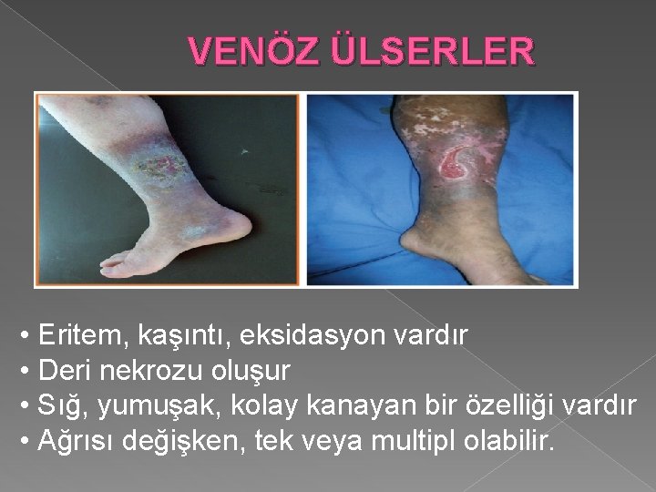 VENÖZ ÜLSERLER • Eritem, kaşıntı, eksidasyon vardır • Deri nekrozu oluşur • Sığ, yumuşak,