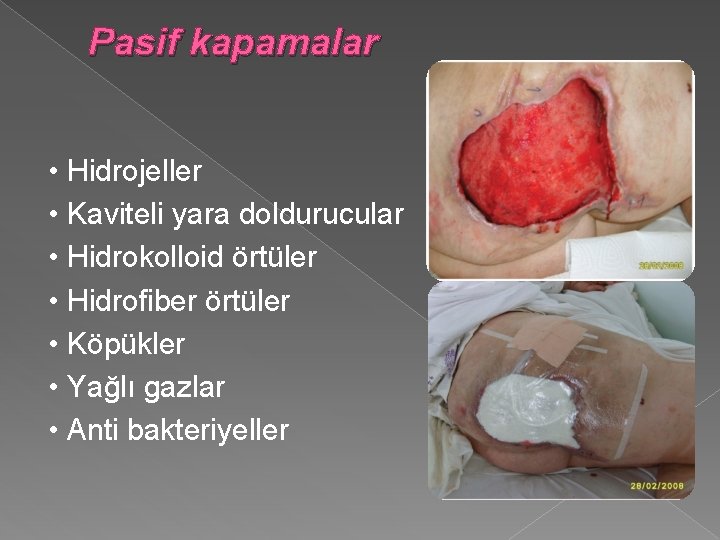 Pasif kapamalar • Hidrojeller • Kaviteli yara doldurucular • Hidrokolloid örtüler • Hidrofiber örtüler