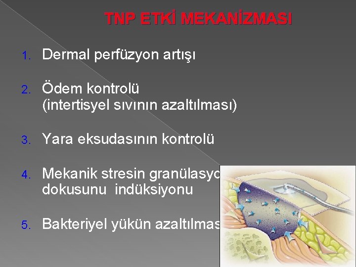 TNP ETKİ MEKANİZMASI 1. Dermal perfüzyon artışı 2. Ödem kontrolü (intertisyel sıvının azaltılması) 3.