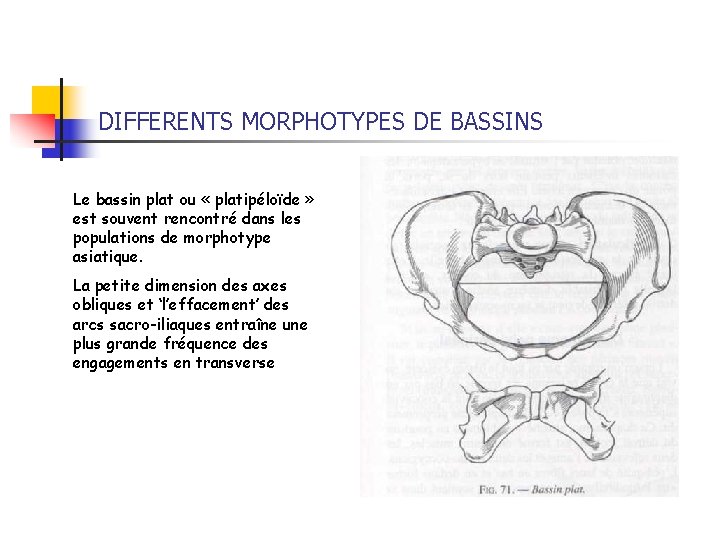 DIFFERENTS MORPHOTYPES DE BASSINS Le bassin plat ou « platipéloïde » est souvent rencontré