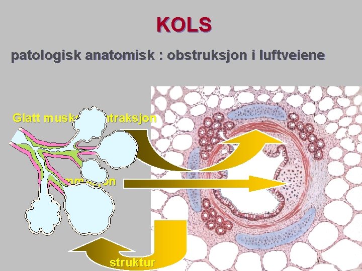 KOLS patologisk anatomisk : obstruksjon i luftveiene Glatt muskel kontraksjon Inflammasjon struktur 
