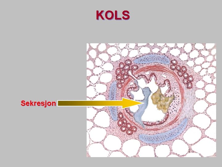 KOLS Sekresjon 