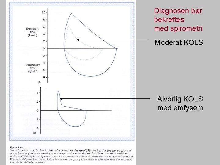 Diagnosen bør bekreftes med spirometri Moderat KOLS Alvorlig KOLS med emfysem 