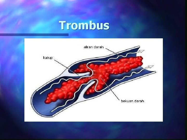 Trombus 