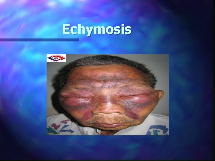 Echymosis 