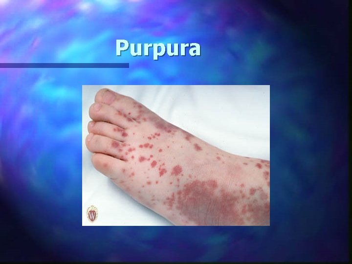 Purpura 