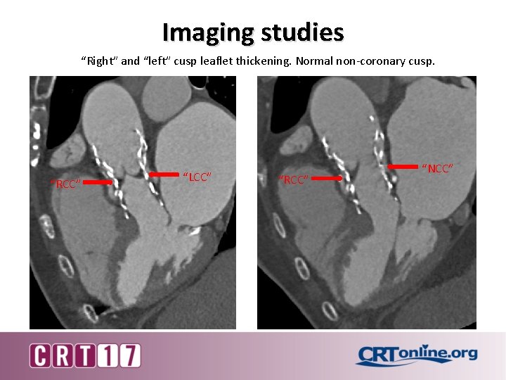 Imaging studies “Right” and “left” cusp leaflet thickening. Normal non-coronary cusp. “RCC” “LCC” “RCC”