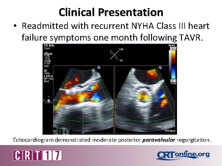 Clinical Presentation • Readmitted with recurrent NYHA Class III heart failure symptoms one month