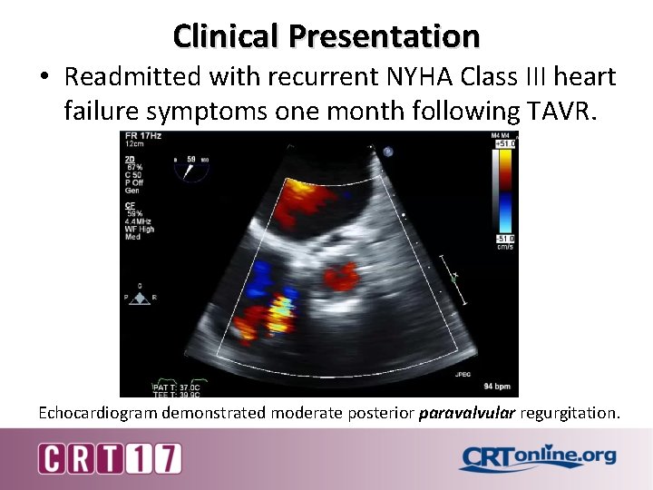 Clinical Presentation • Readmitted with recurrent NYHA Class III heart failure symptoms one month