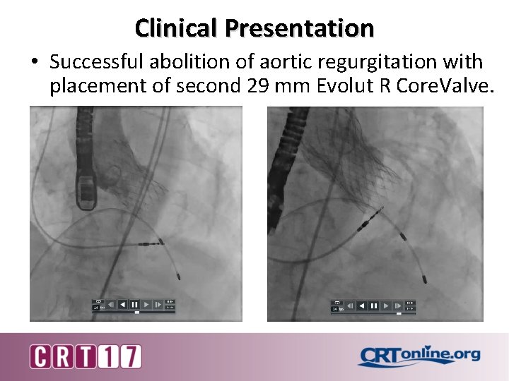 Clinical Presentation • Successful abolition of aortic regurgitation with placement of second 29 mm
