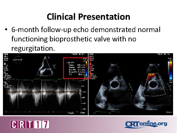 Clinical Presentation • 6 -month follow-up echo demonstrated normal functioning bioprosthetic valve with no