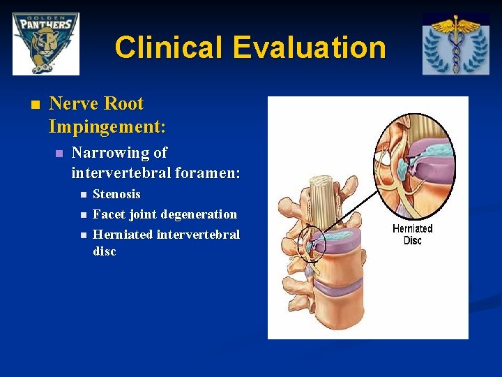 Clinical Evaluation n Nerve Root Impingement: n Narrowing of intervertebral foramen: n n n