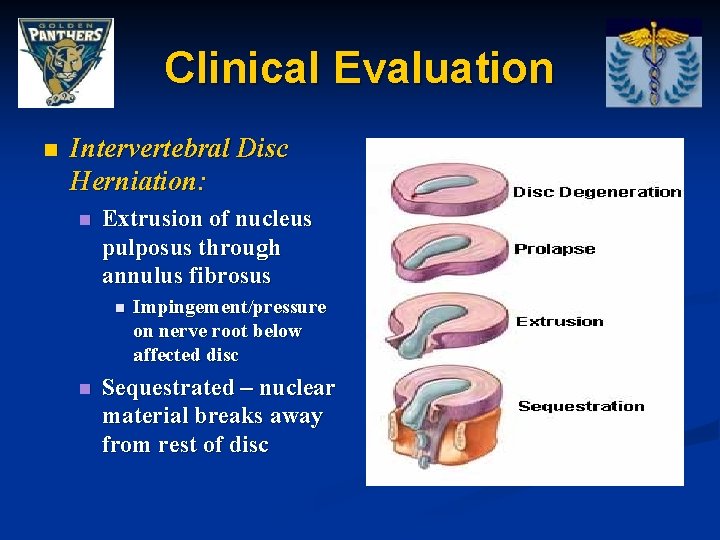 Clinical Evaluation n Intervertebral Disc Herniation: n Extrusion of nucleus pulposus through annulus fibrosus