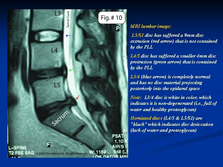 MRI lumbar image: L 5/S 1 disc has suffered a 9 mm disc extrusion