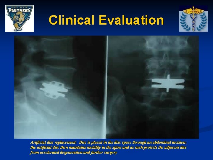 Clinical Evaluation Artificial disc replacement: Disc is placed in the disc space through an