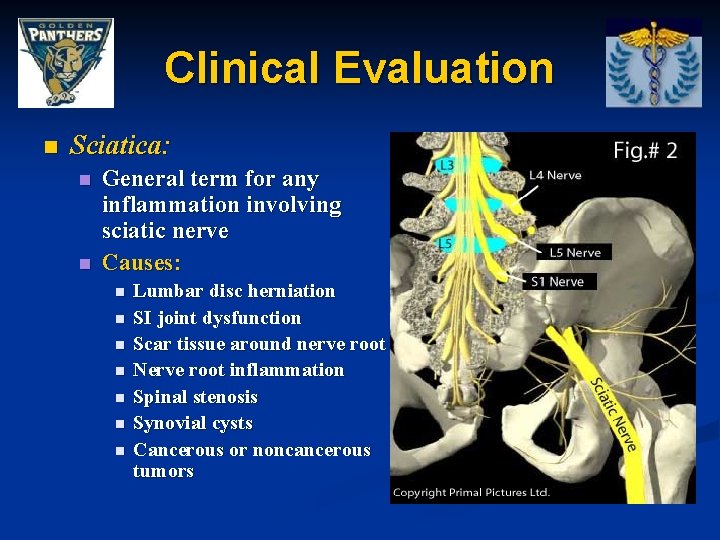 Clinical Evaluation n Sciatica: n n General term for any inflammation involving sciatic nerve