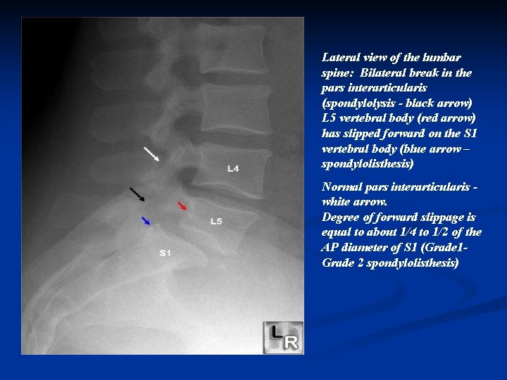 Lateral view of the lumbar spine: Bilateral break in the pars interarticularis (spondylolysis -