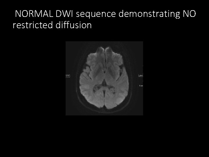 NORMAL DWI sequence demonstrating NO restricted diffusion 