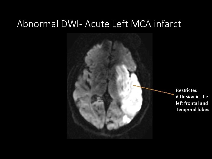 Abnormal DWI- Acute Left MCA infarct Restricted diffusion in the left frontal and Temporal