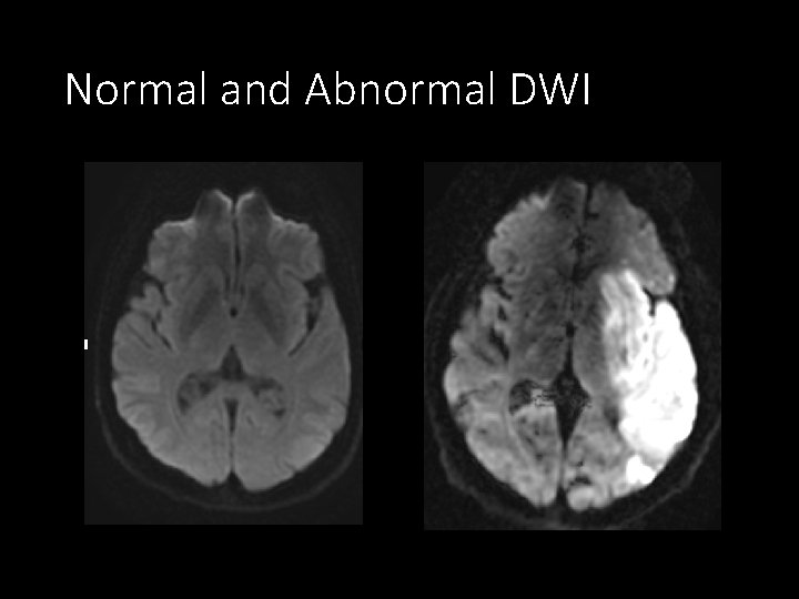 Normal and Abnormal DWI 