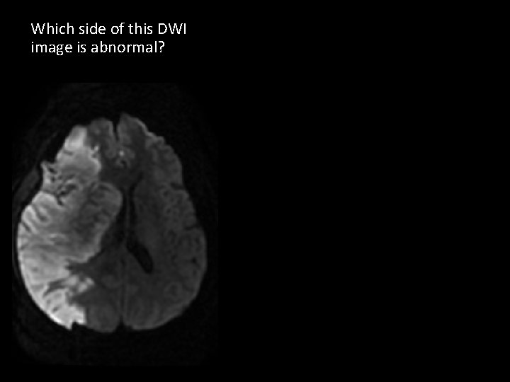 Which side of this DWI image is abnormal? 