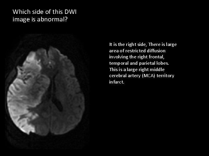 Which side of this DWI image is abnormal? It is the right side, There