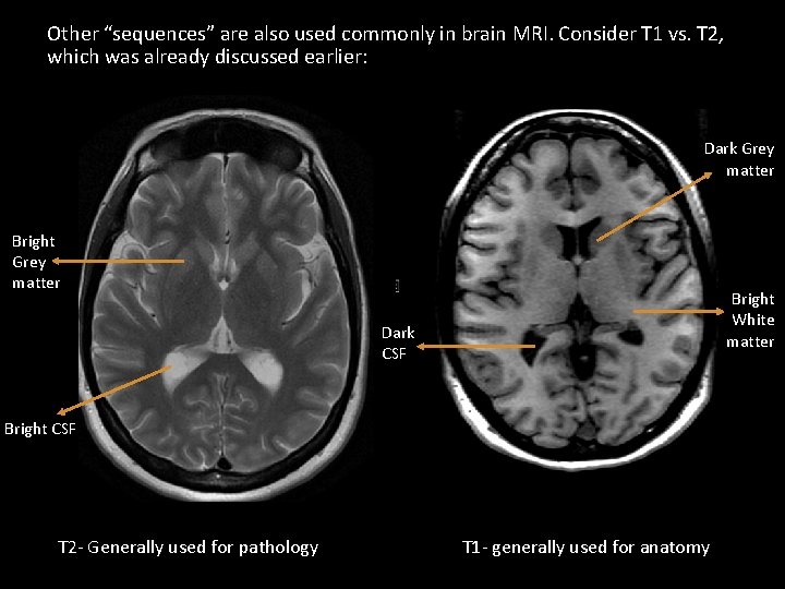 Other “sequences” are also used commonly in brain MRI. Consider T 1 vs. T