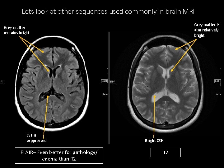 Lets look at other sequences used commonly in brain MRI Grey matter is also