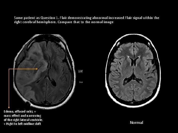 Same patient as Question 1. Flair demonstrating abnormal increased Flair signal within the right