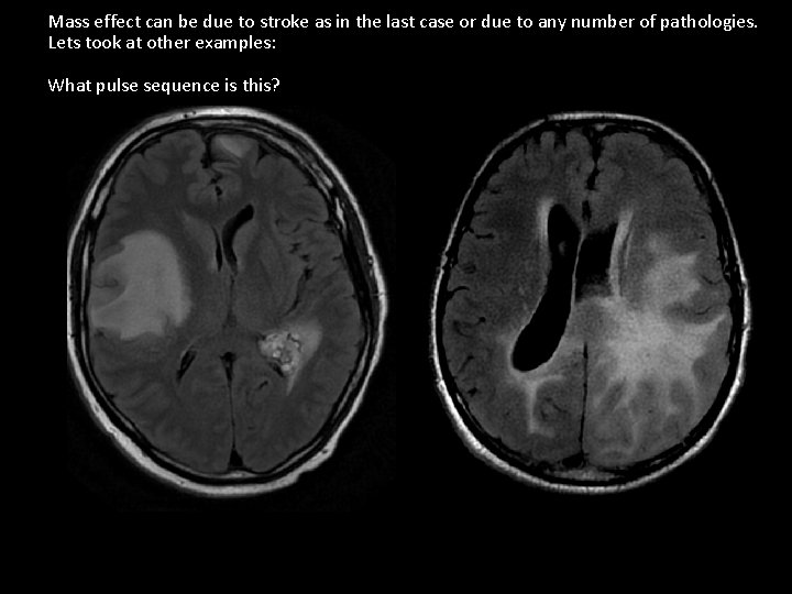 Mass effect can be due to stroke as in the last case or due