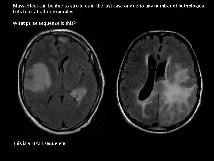 Mass effect can be due to stroke as in the last case or due