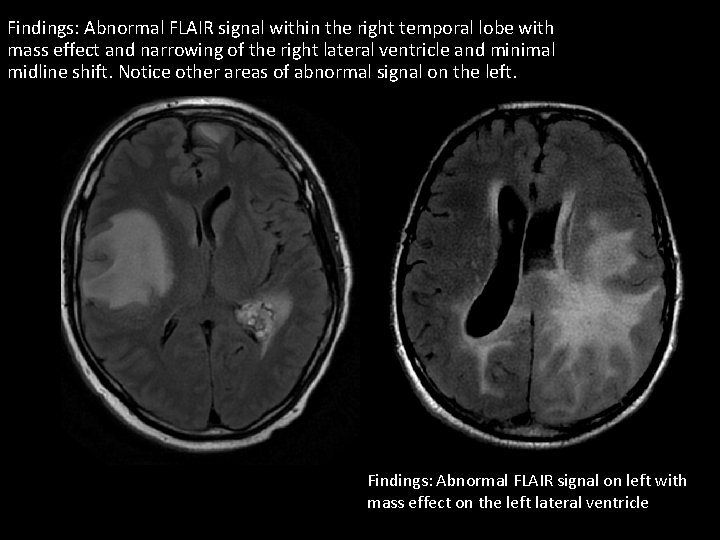 Findings: Abnormal FLAIR signal within the right temporal lobe with mass effect and narrowing