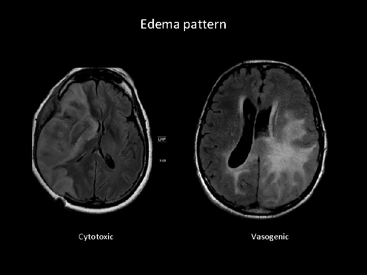 Edema pattern Cytotoxic Vasogenic 