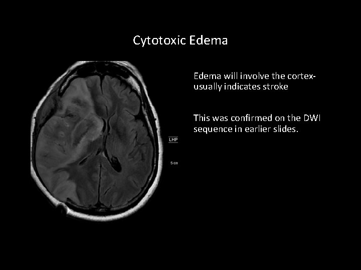 Cytotoxic Edema will involve the cortexusually indicates stroke This was confirmed on the DWI
