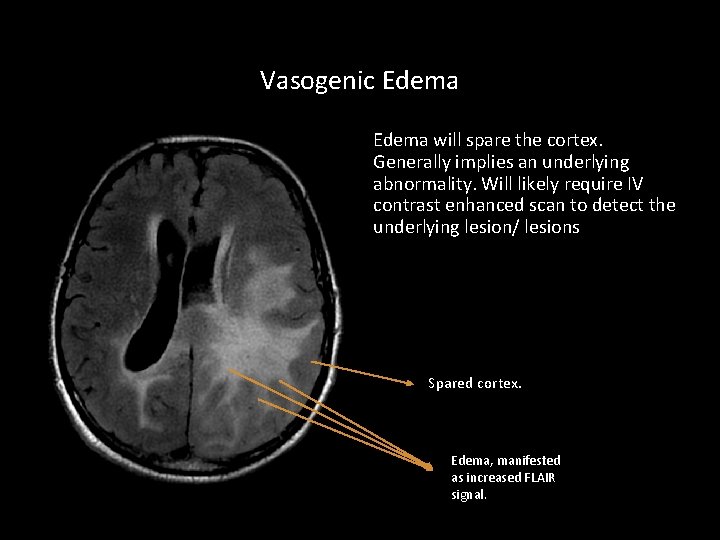 Vasogenic Edema will spare the cortex. Generally implies an underlying abnormality. Will likely require