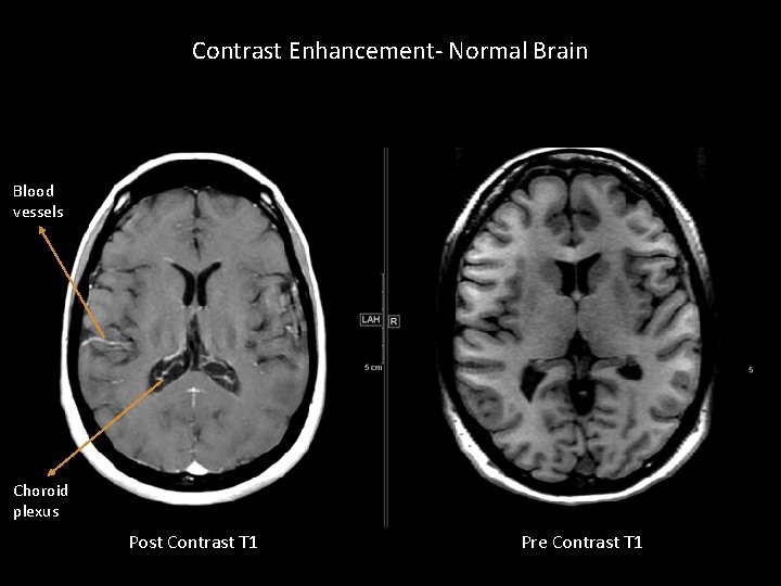 Contrast Enhancement- Normal Brain Blood vessels Choroid plexus Post Contrast T 1 Pre Contrast