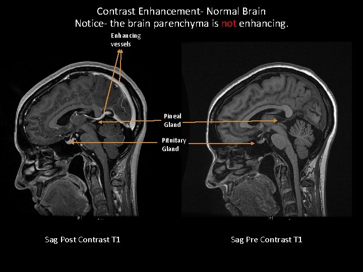 Contrast Enhancement- Normal Brain Notice- the brain parenchyma is not enhancing. Enhancing vessels Pineal