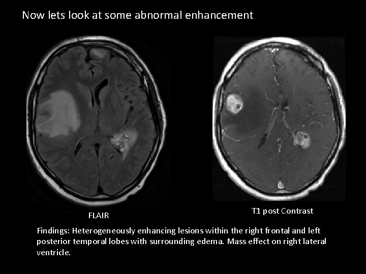 Now lets look at some abnormal enhancement FLAIR T 1 post Contrast Findings: Heterogeneously
