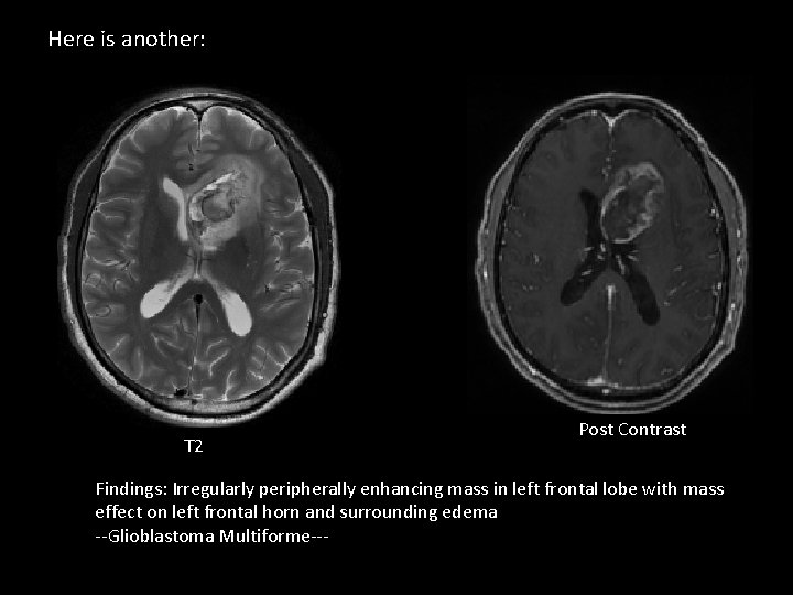 Here is another: T 2 Post Contrast Findings: Irregularly peripherally enhancing mass in left