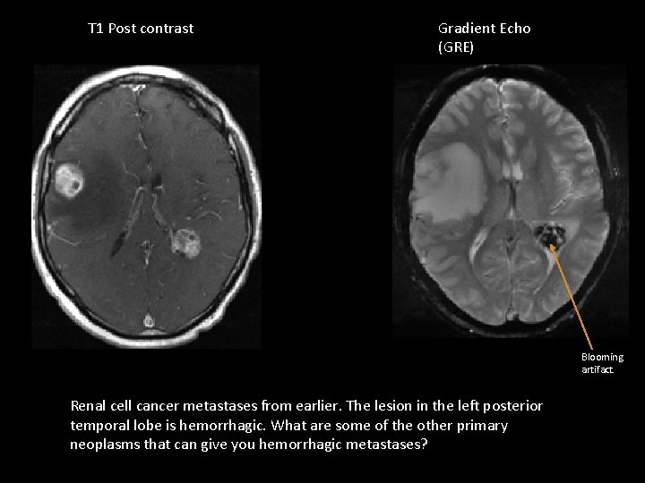 T 1 Post contrast Gradient Echo (GRE) Blooming artifact. Renal cell cancer metastases from