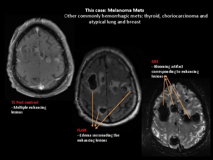 This case: Melanoma Mets Other commonly hemorrhagic mets: thyroid, choriocarcinoma and atypical lung and