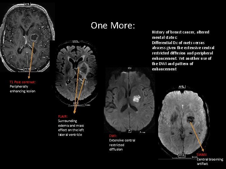 One More: History of breast cancer, altered mental status: Differential Dx of mets versus