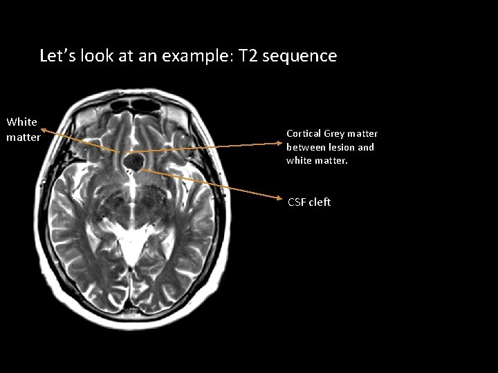Let’s look at an example: T 2 sequence White matter Cortical Grey matter between