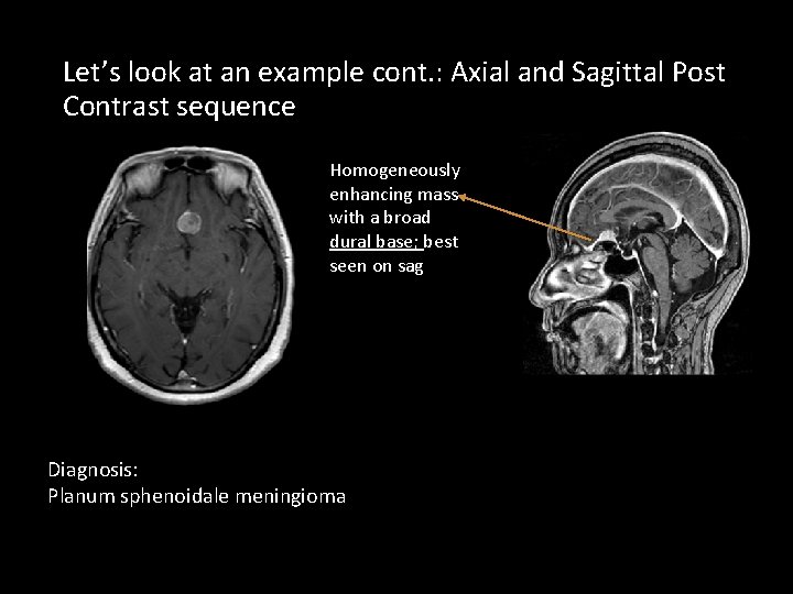Let’s look at an example cont. : Axial and Sagittal Post Contrast sequence Homogeneously