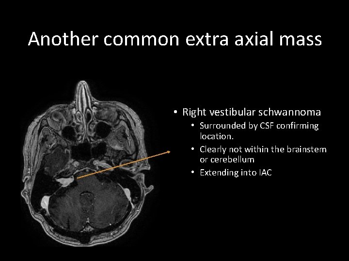 Another common extra axial mass • Right vestibular schwannoma • Surrounded by CSF confirming