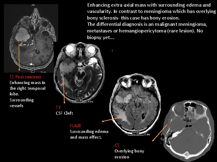 Enhancing extra axial mass with surrounding edema and vascularity. In contrast to meningioma which