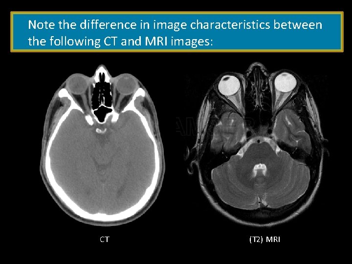 Note the difference in image characteristics between the following CT and MRI images: CT